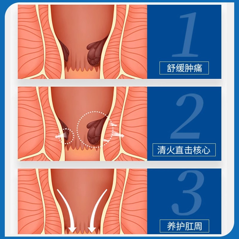 Hemorrhoid Ointment Is a Special Effect Medicine That Eliminates Hemorrhoids and Reduces Flesh Lumps. Medical Carbomer Hemorrhoid Gel Dressing Eliminates Hemorrhoids and Relieves Itching. Small Blue Tube